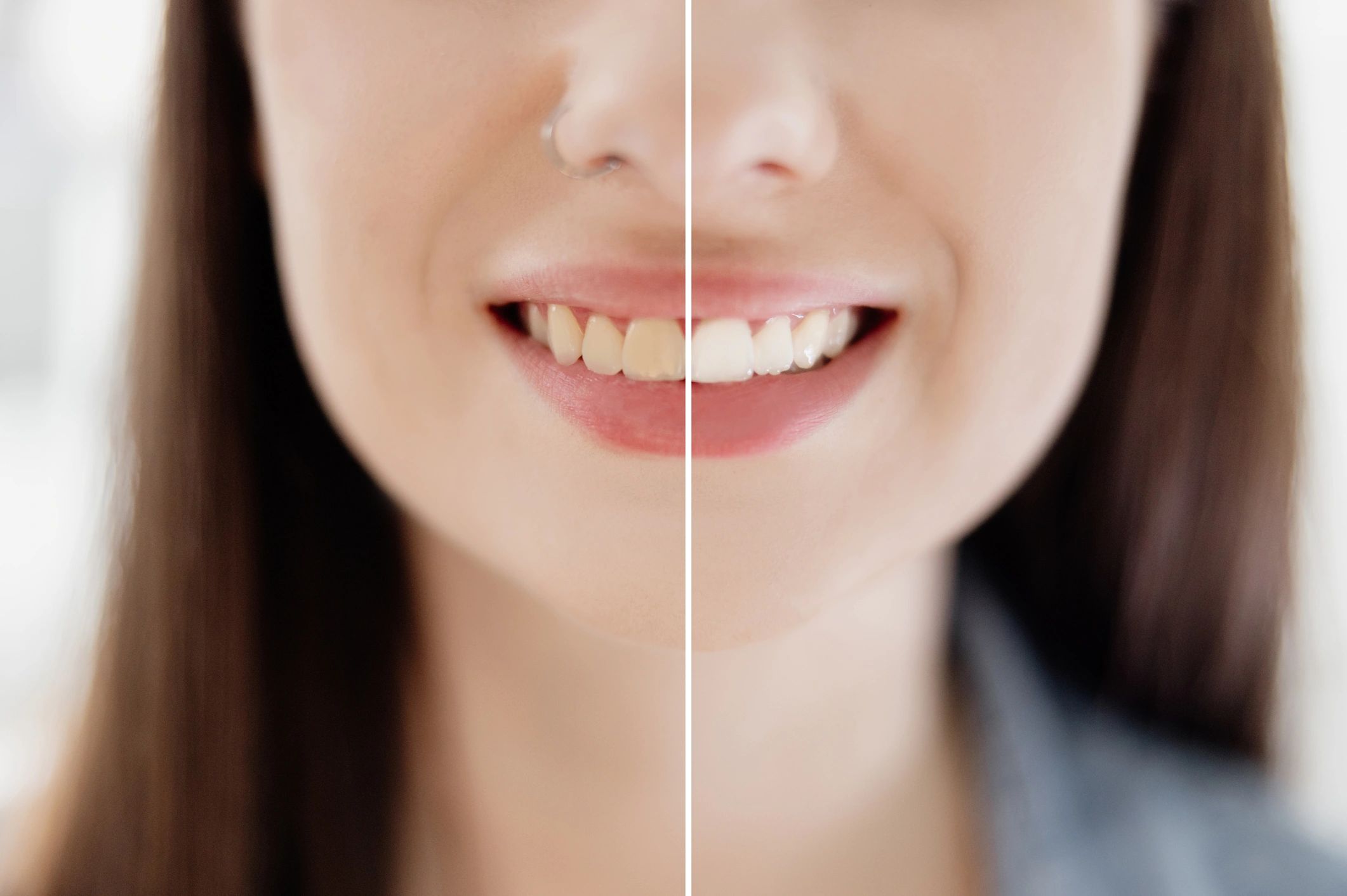 Before and after teeth whitening comparison